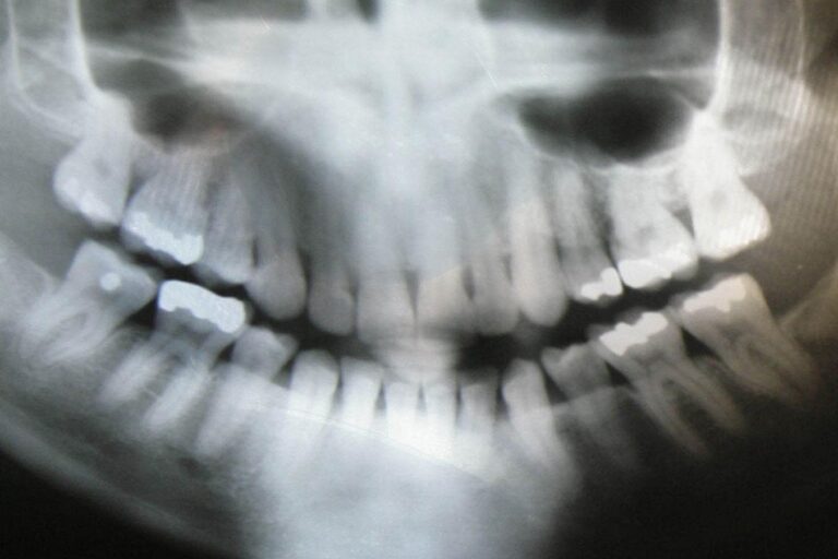 Are you getting an X-ray at the dentist? A recent suggestion states that a lead apron is unnecessary.