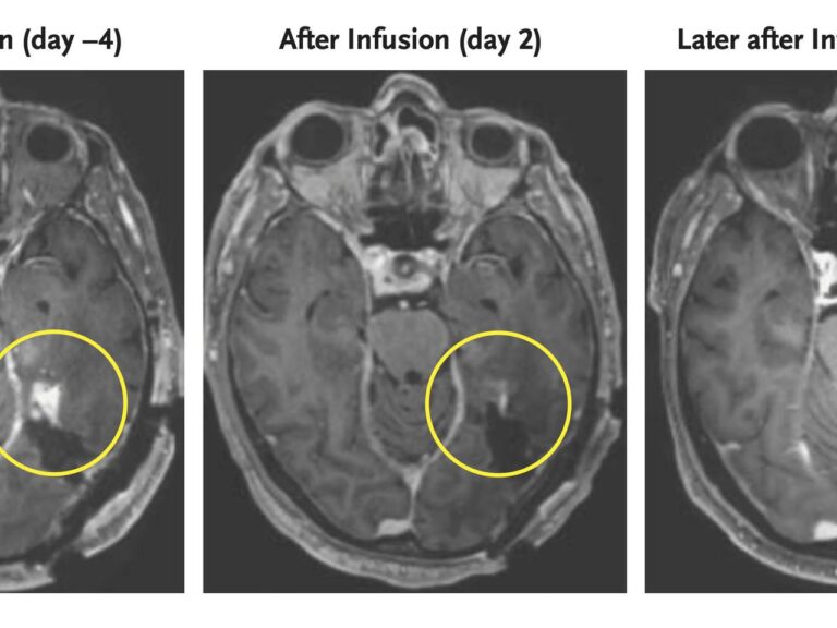 New research has shown promise in shrinking tumors in patients with aggressive brain cancer through a new attack strategy. The strategy has been successful in two initial trials.