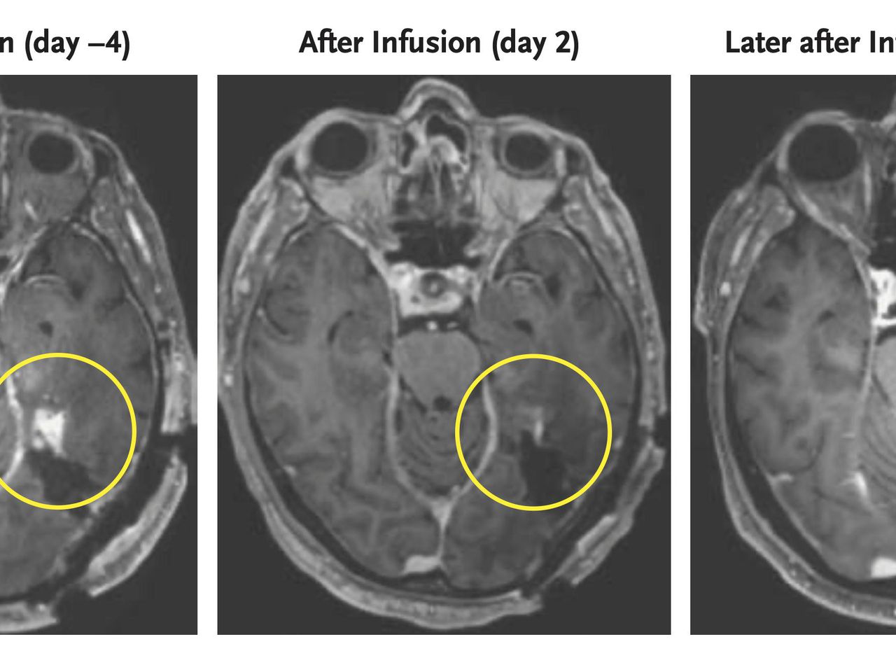 New research has shown promise in shrinking tumors in patients with aggressive brain cancer through a new attack strategy. The strategy has been successful in two initial trials.