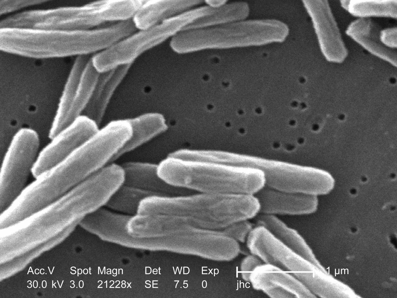 US tuberculosis cases were at the highest level in a decade in 2023