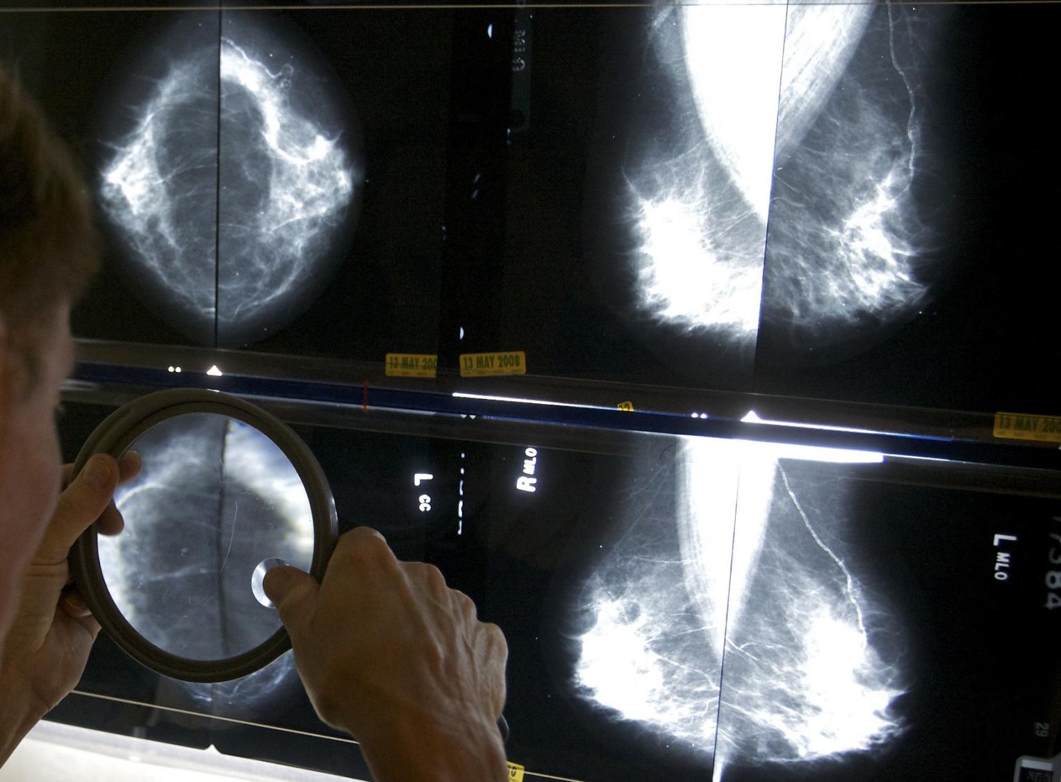 Mammograms should start at 40 to address rising breast cancer rates at younger ages, panel says