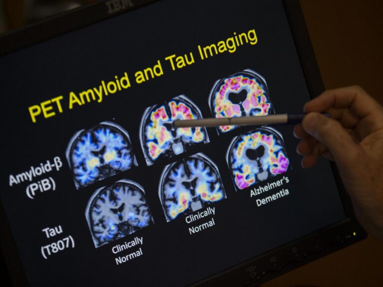 Blood tests for Alzheimer's may be coming to your doctor's office. Here's what to know