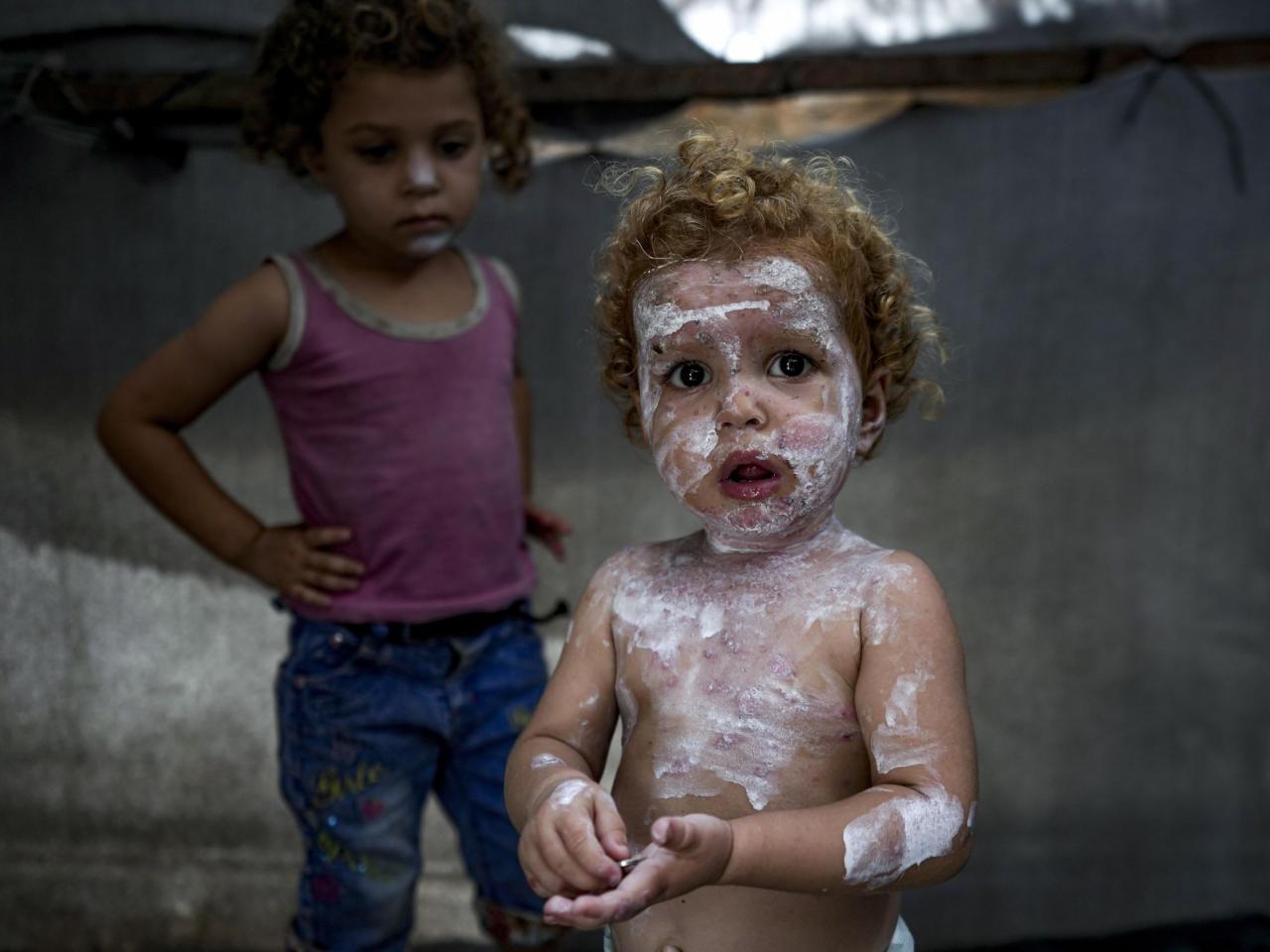 Lice, scabies, rashes plague Palestinian children as skin disease runs rampant in Gaza's tent camps