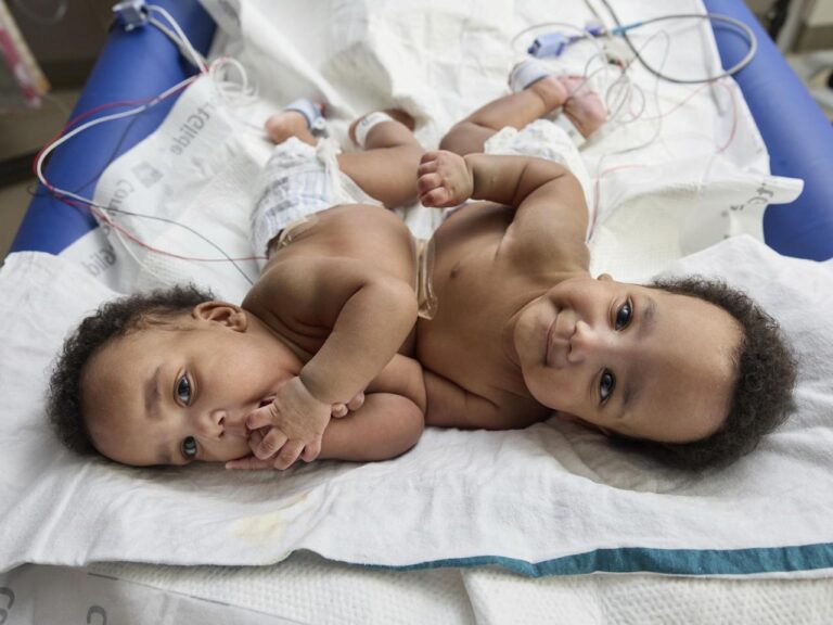 Twin boys born conjoined celebrate 1st birthday after separation surgery