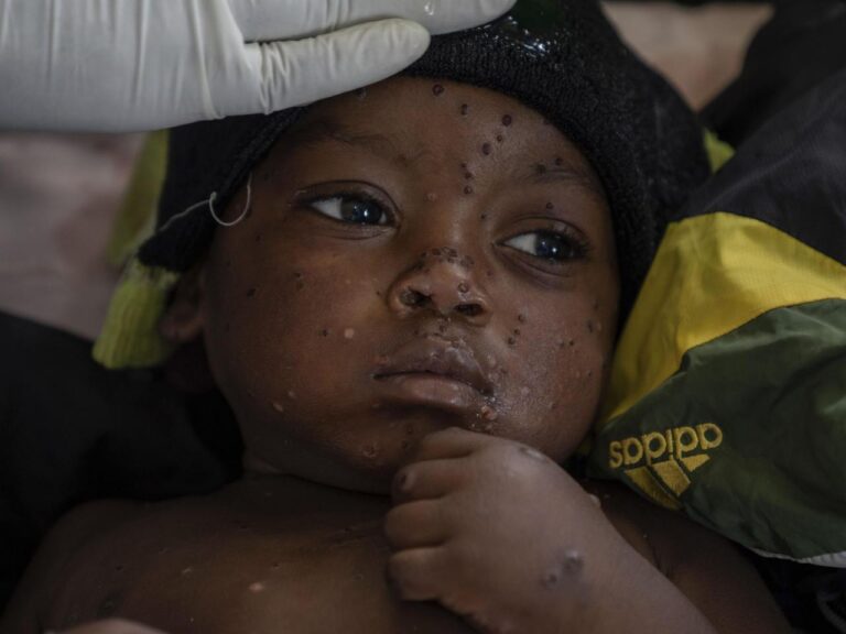 Mpox cases in Congo may be stabilizing. Experts say more vaccines are needed to stamp out virus