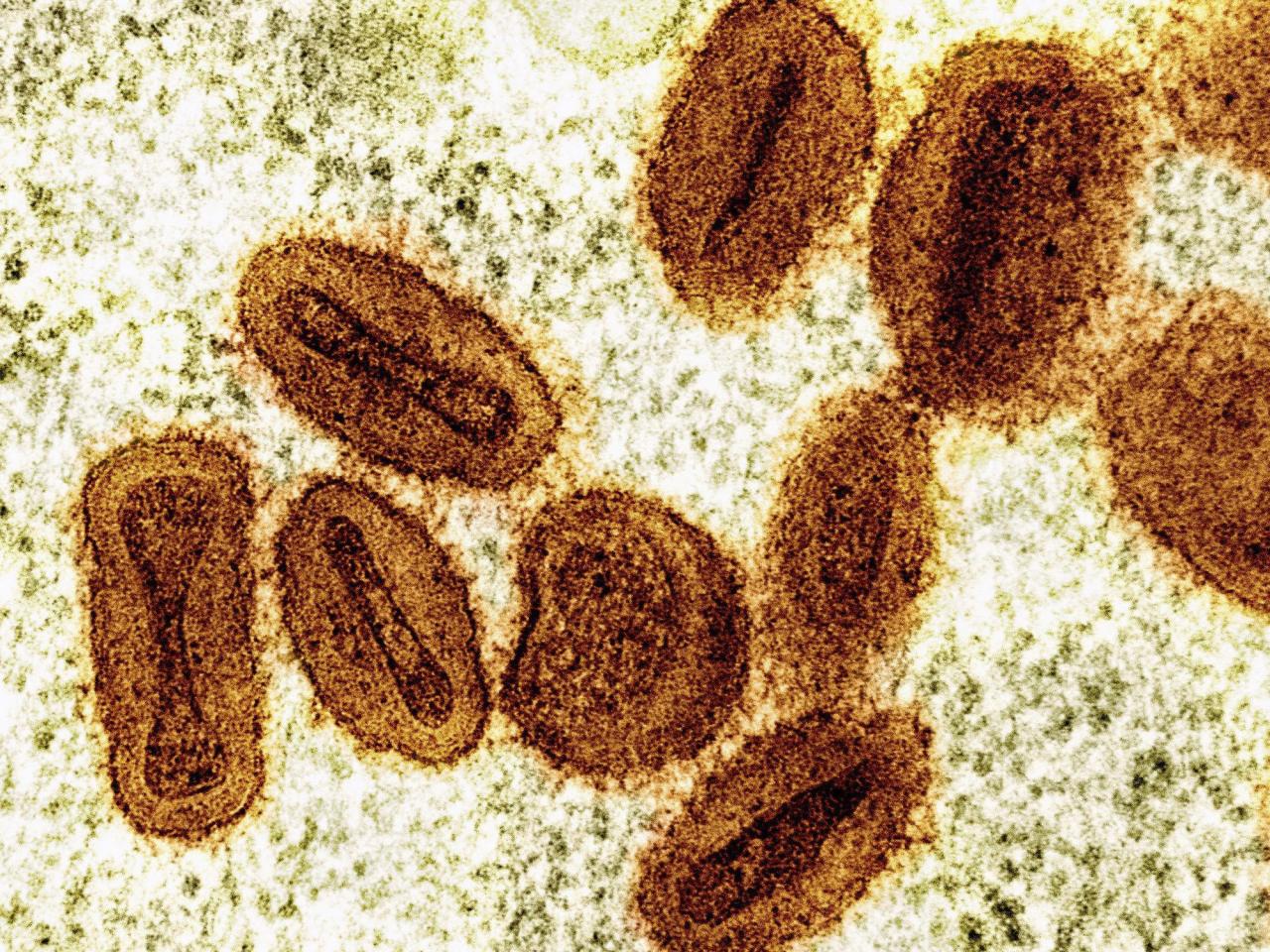 US health officials report 1st case of new form of mpox in a traveler