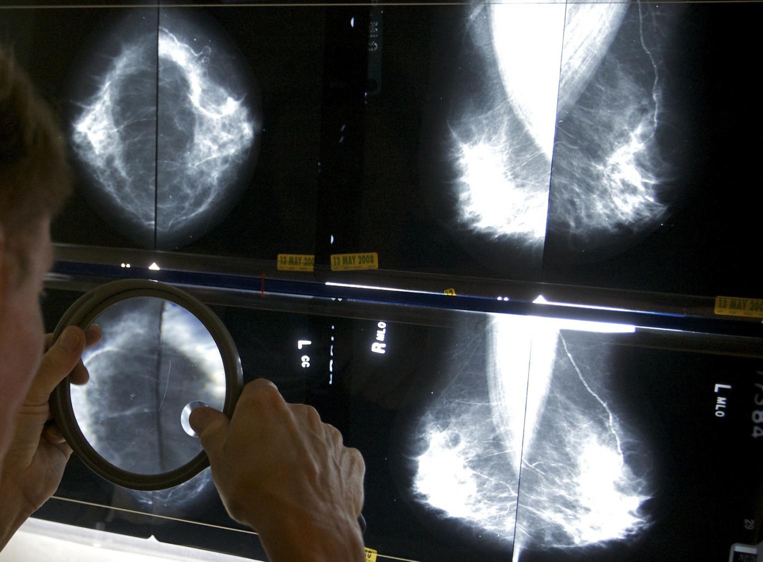 Cancer before age 50 is increasing. A new study looks at which types